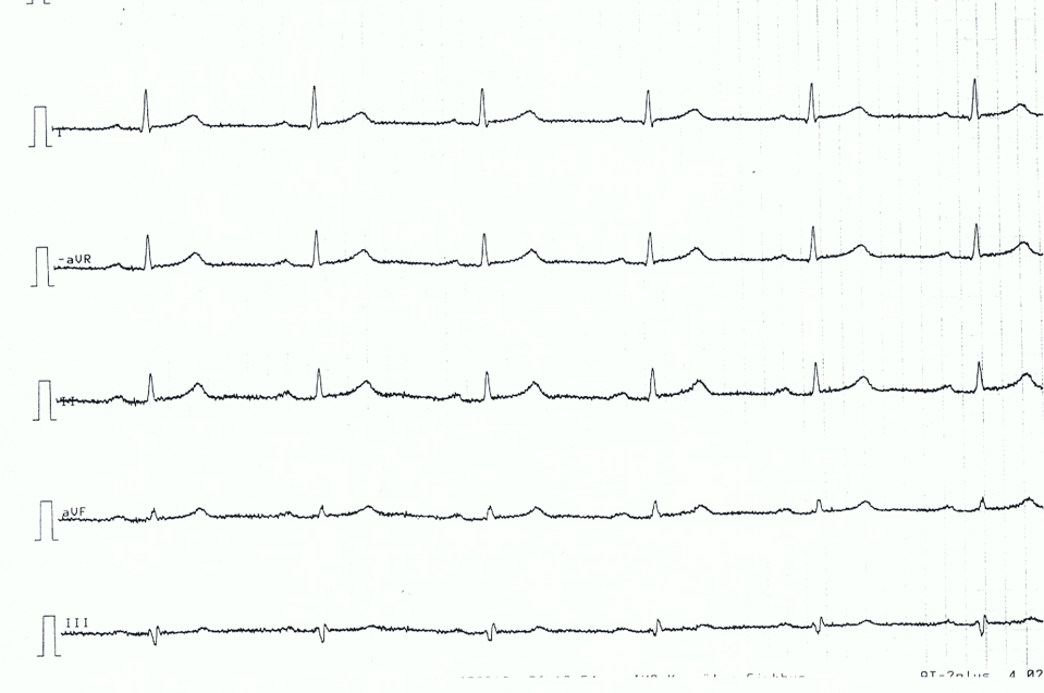 Figure 4. Limb leads of patient with acute pericarditis. Note the very discrete, but generalized, ST segment elevations, concave ST segments.
