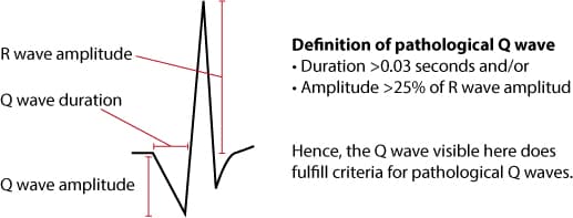 Figure 11. Criteria for pathological Q-waves.