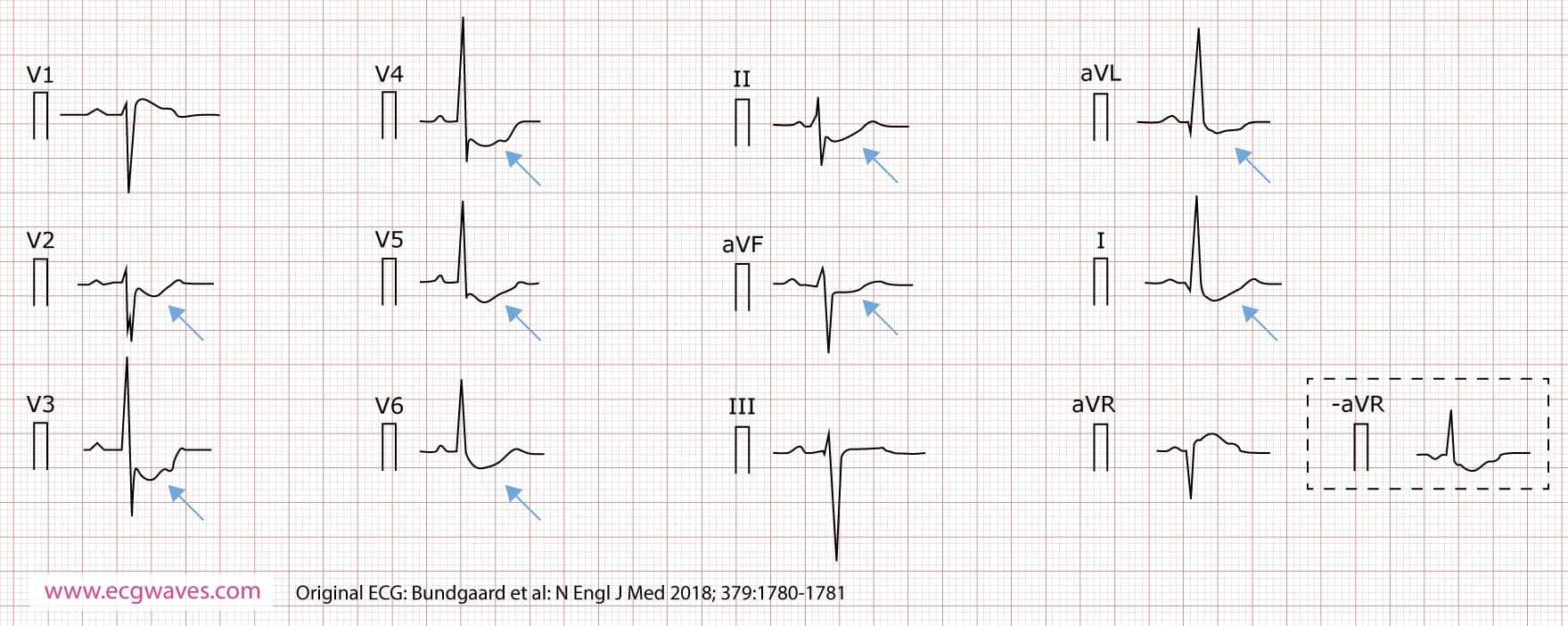 12-lead ECG (presented according to Cabrera), recorded at 63 years of age, demonstrates concave-upward ST-segment depression in leads I, II, aVL, aVF, and V2 through V6; and ST-segment elevation in lead aVR (which corresponds to an identical ST-segment depression in the inverted lead -aVR). A notch is evident in the ascending part of the ST segment.