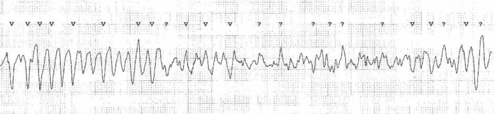 Polymorphic ventricular tachycardia degenerating into ventricular fibrillation.