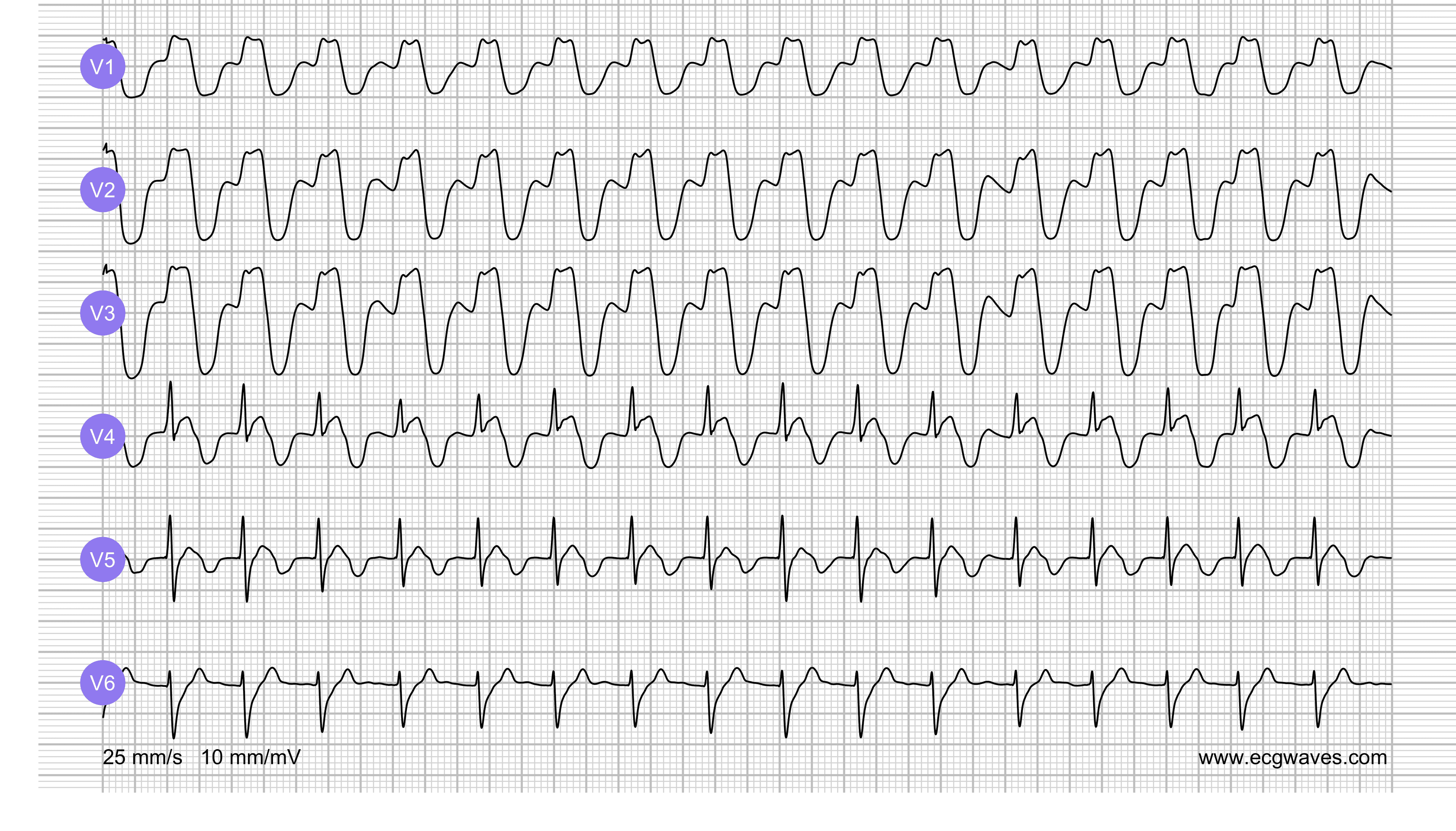 ECG Test (Quiz) Library: Question 1, ECG 2