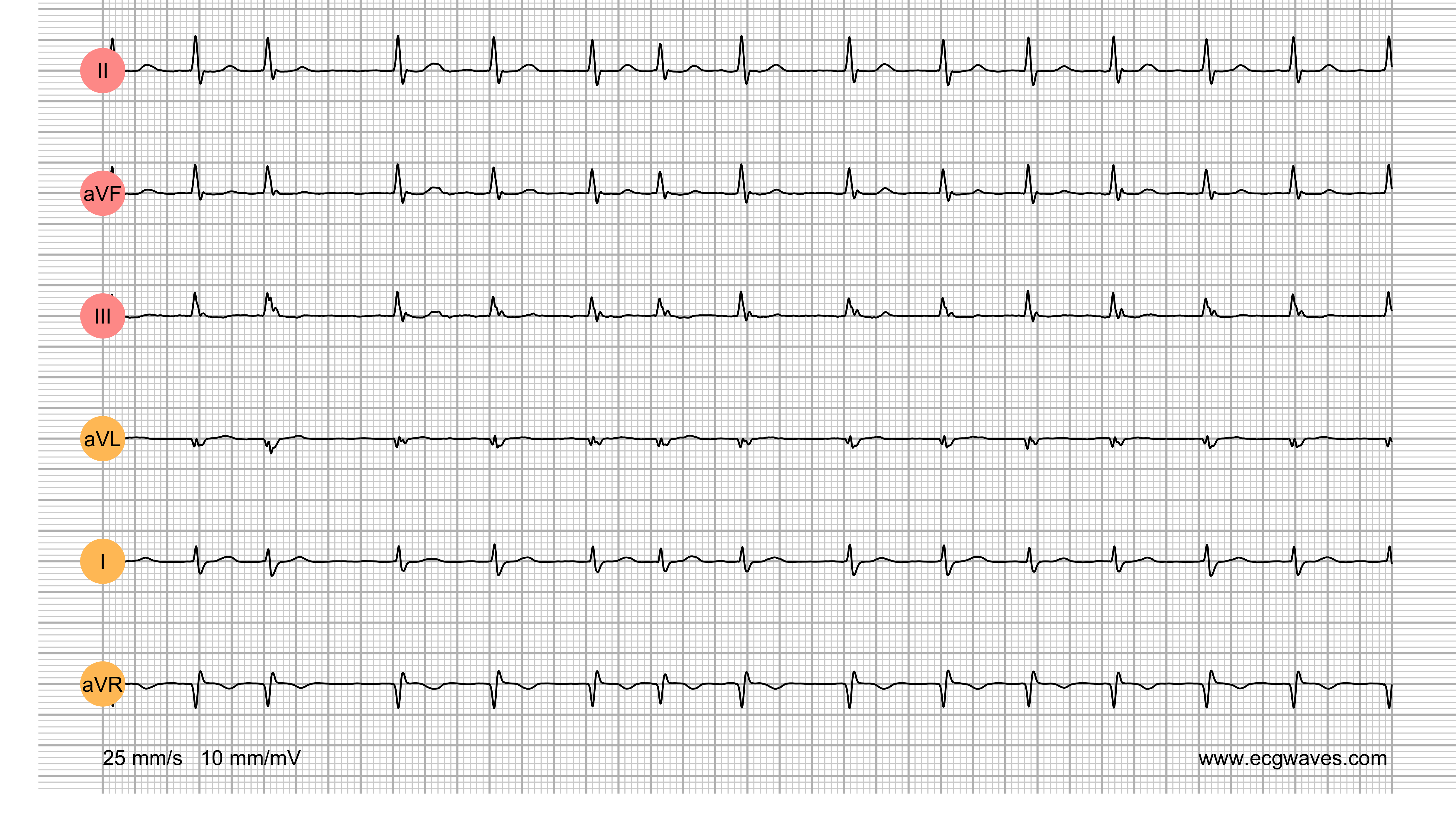 ECG Test (Quiz) Library: Question 2