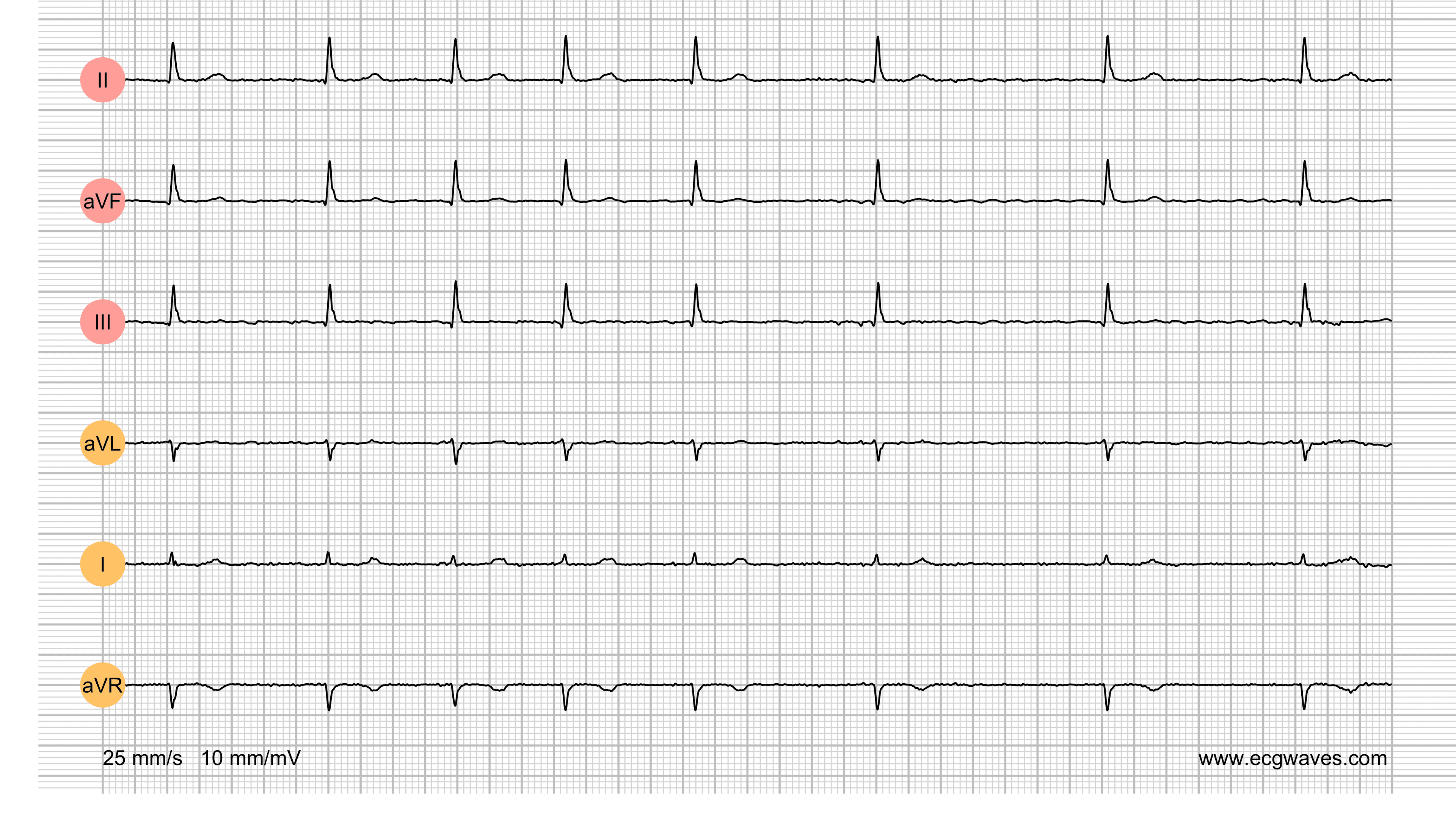 ECG Test (Quiz) Library: Question 3