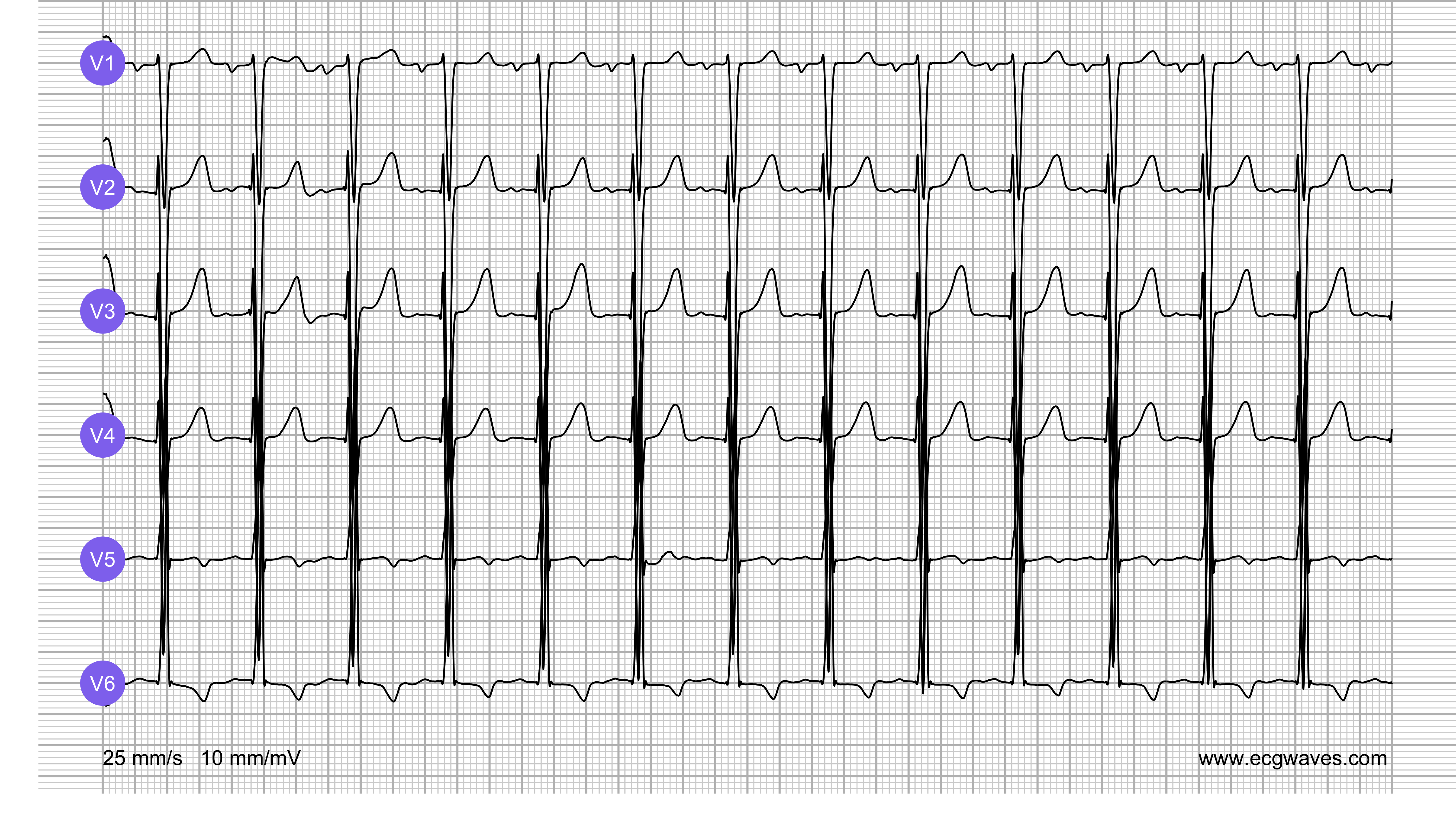 ECG Test (Quiz) Library: Question 6