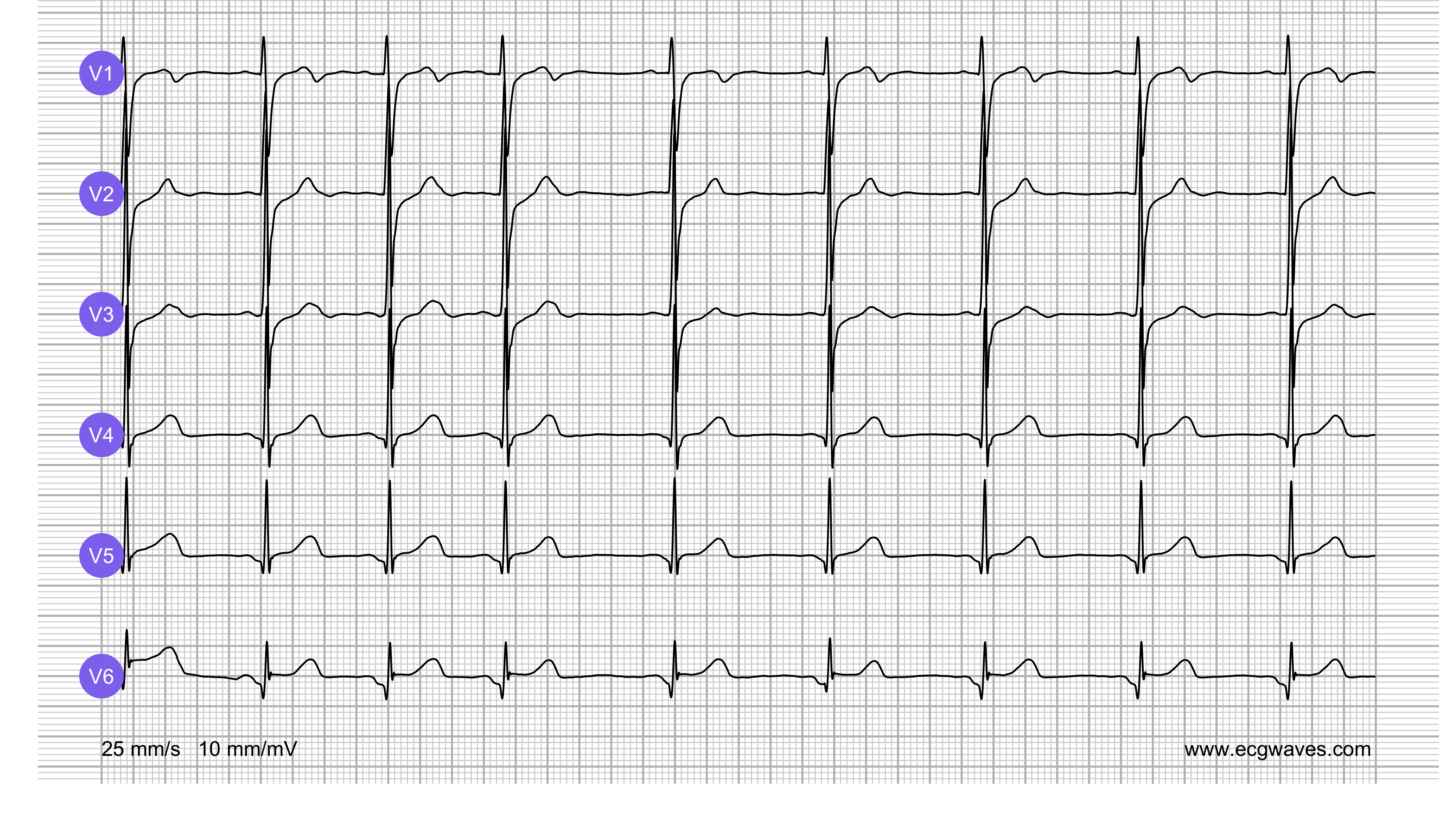 ECG Test (Quiz) Library: Question 8