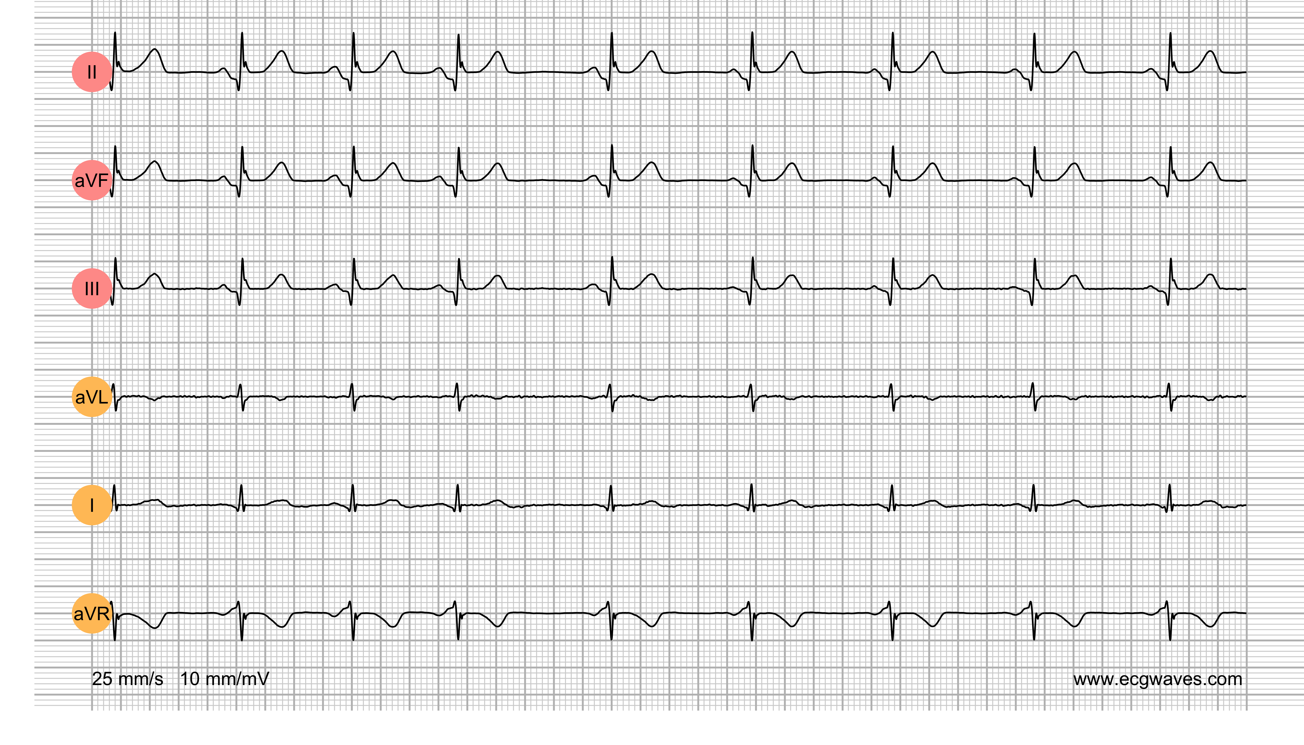 ECG Test (Quiz) Library: Question 8