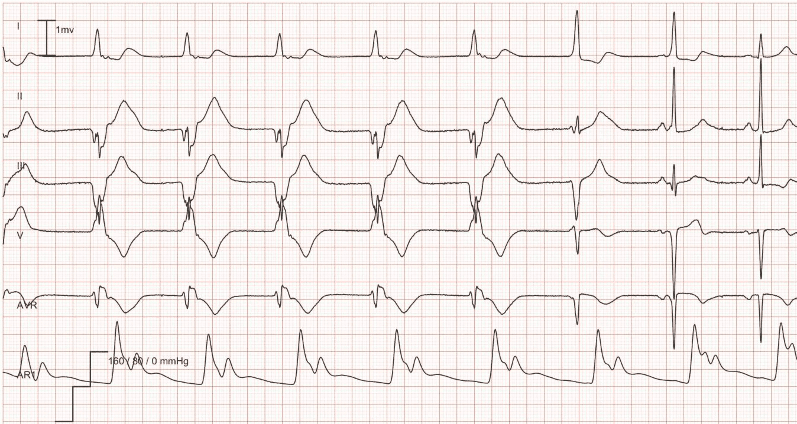 ECG Example: Idioventricular rhythm (accelerated ventricular rhythm) – Accelerated ventricular rhythm at a rate of 56 for the first 5 beats followed by 2 fusion beats; the last 2 beats are normal sinus rhythm.