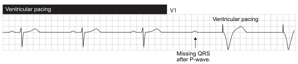 AV block (blocked P-wave) resulting in ventricular pacing.