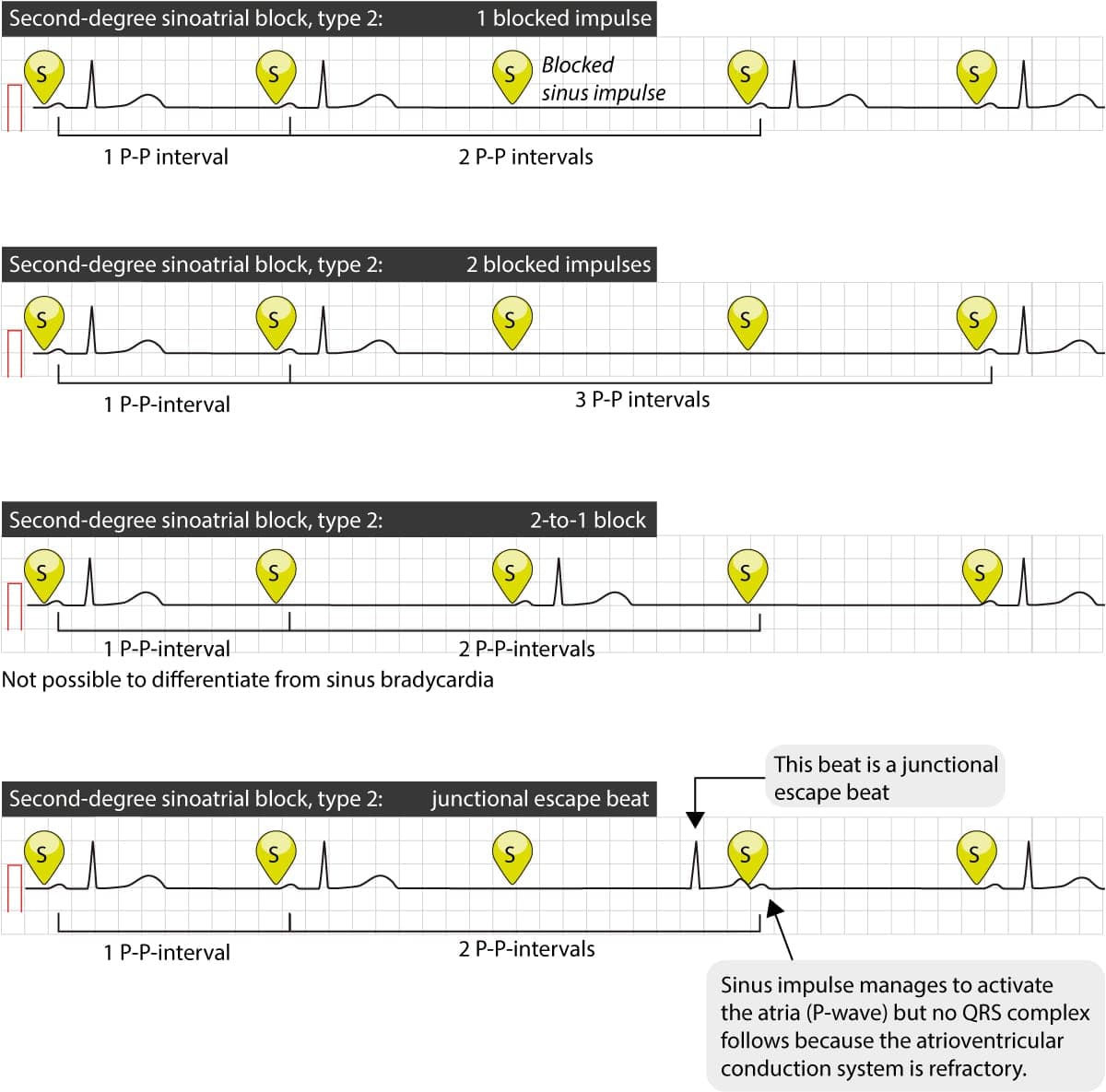 Figure 3. Several cases of type 2 second-degree sinoatrial block.