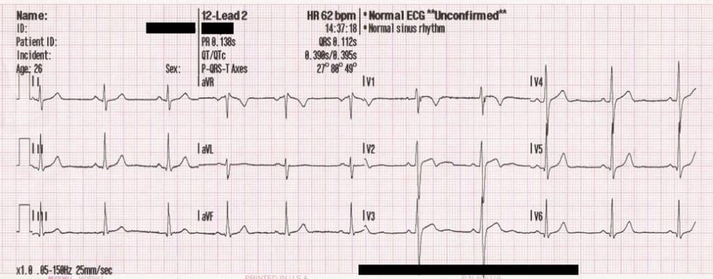 Figure 1. Traditional presentation of the leads in the 12-lead ECG.