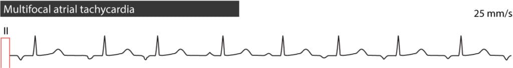 Figure 4. Multifocal atrial tachycardia