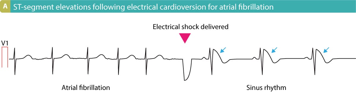 Figure 12. Electrical cardioversion resulting in ST-segment elevations.