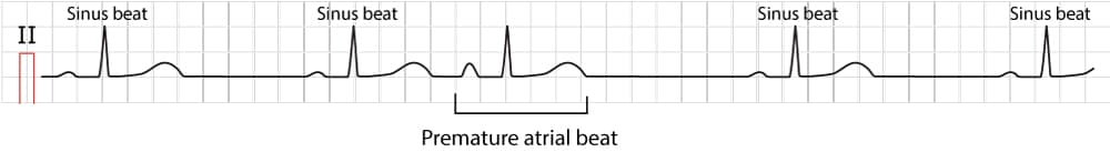 Figure 1. Typical premature atrial contraction (beat / complex).