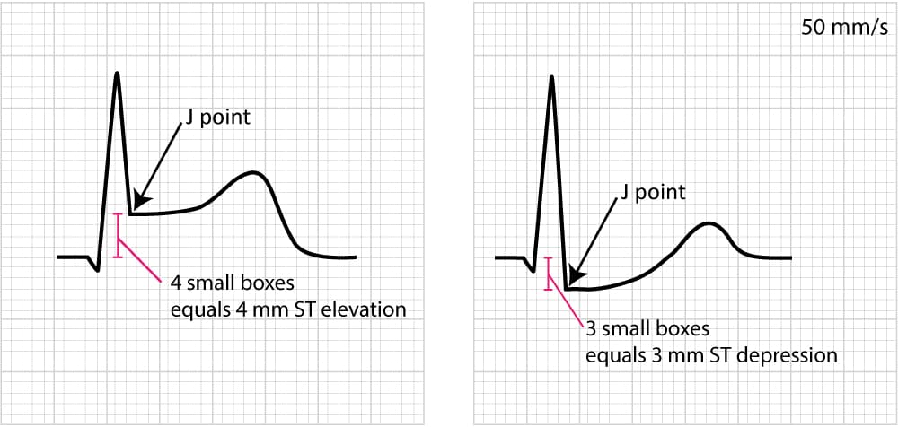Figure 14. Example of measuring ST deviation (elevation and depression).