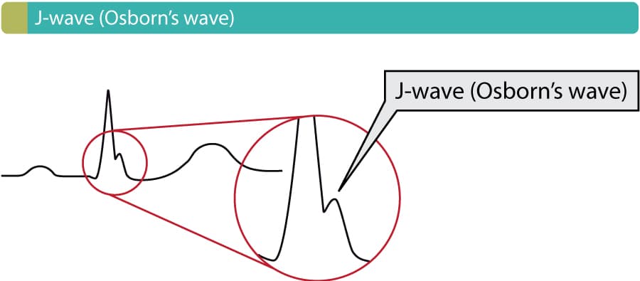 Figure 1. Osborn wave (J wave). These waves occur due to hypothermia, hypercalcemia, early repolarization and Brugada syndrome.