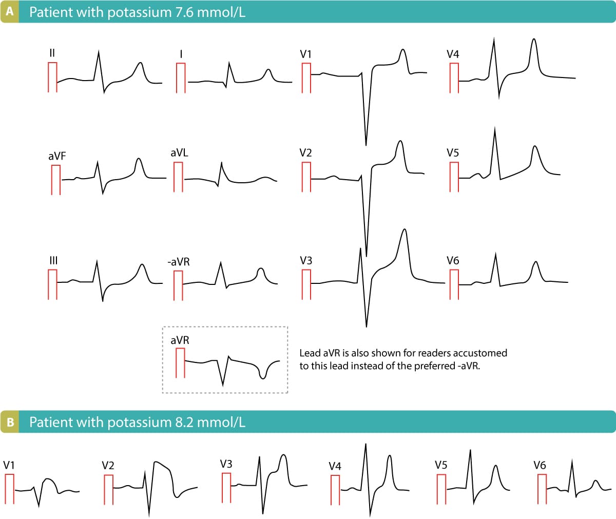 Figure 9. ST-segment elevations due to hyperkalemia.