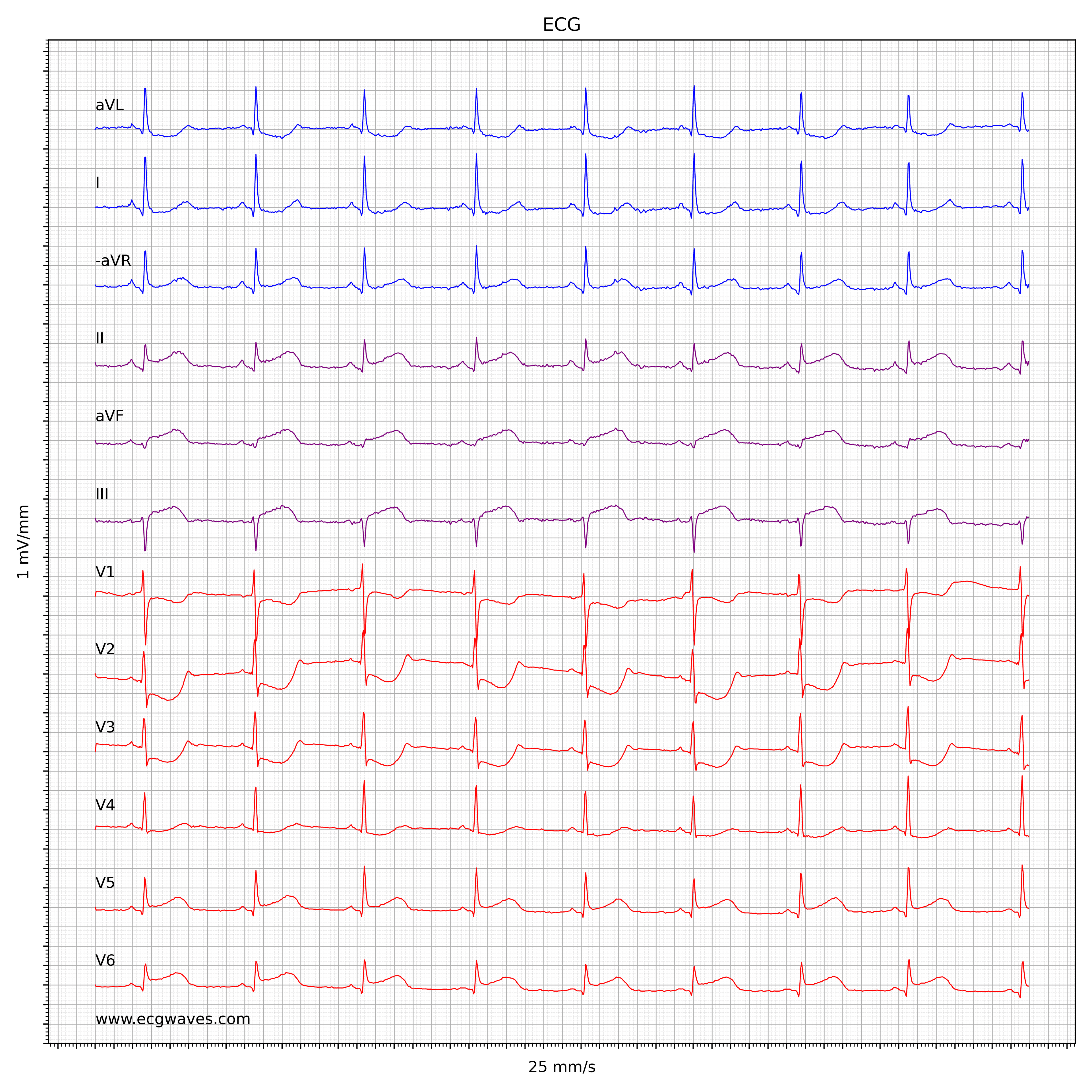 ECG Test 3 - Question 1