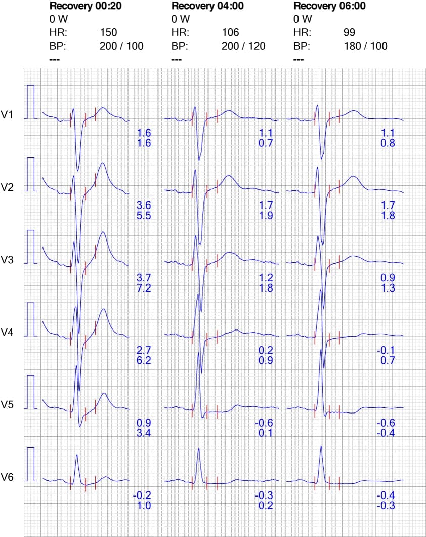 Figure 10. ECG reaction in chest leads during recovery.