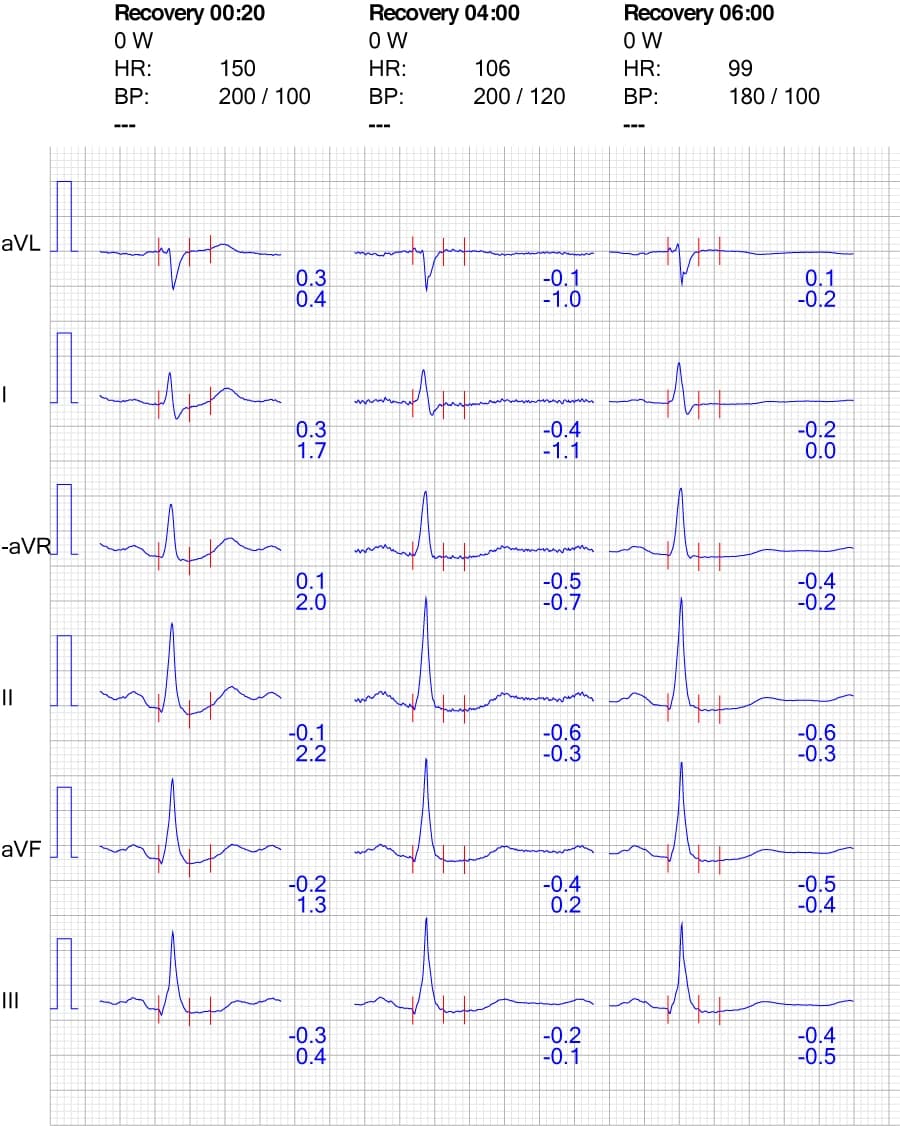 Figure 8. ECG reaction in limb leads during recovery.