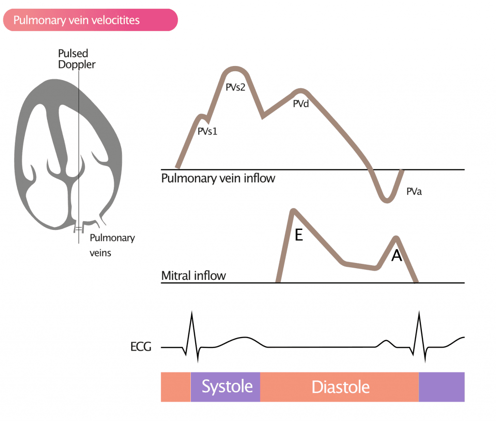 Figure 5. Measurement of pulmonary vein velocities with pulsed Doppler.
