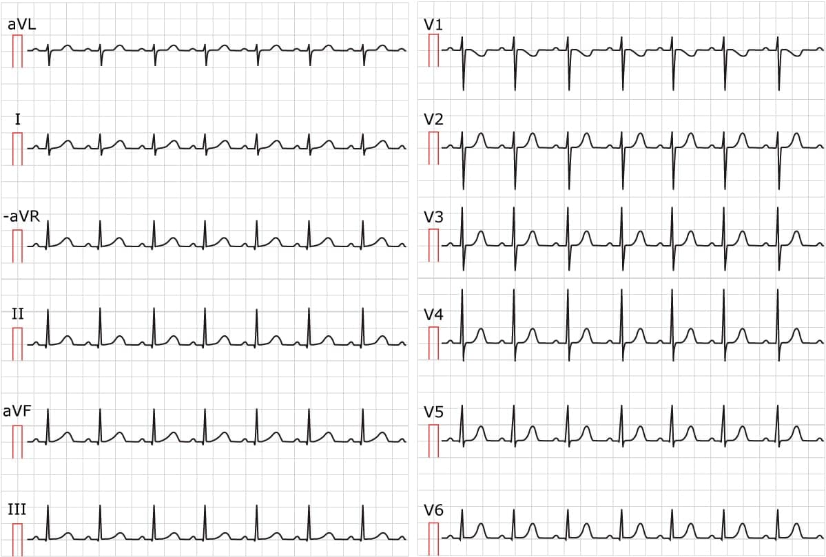 Figure 1. ECG showing sinus tachycardia. Paper speed 25 mm/s. Calculate the heart rate by dividing 300 by the number of large boxes between R-waves. There are approximately 3 large boxes between the R-waves; 300/3 equals 100 beats per minute.